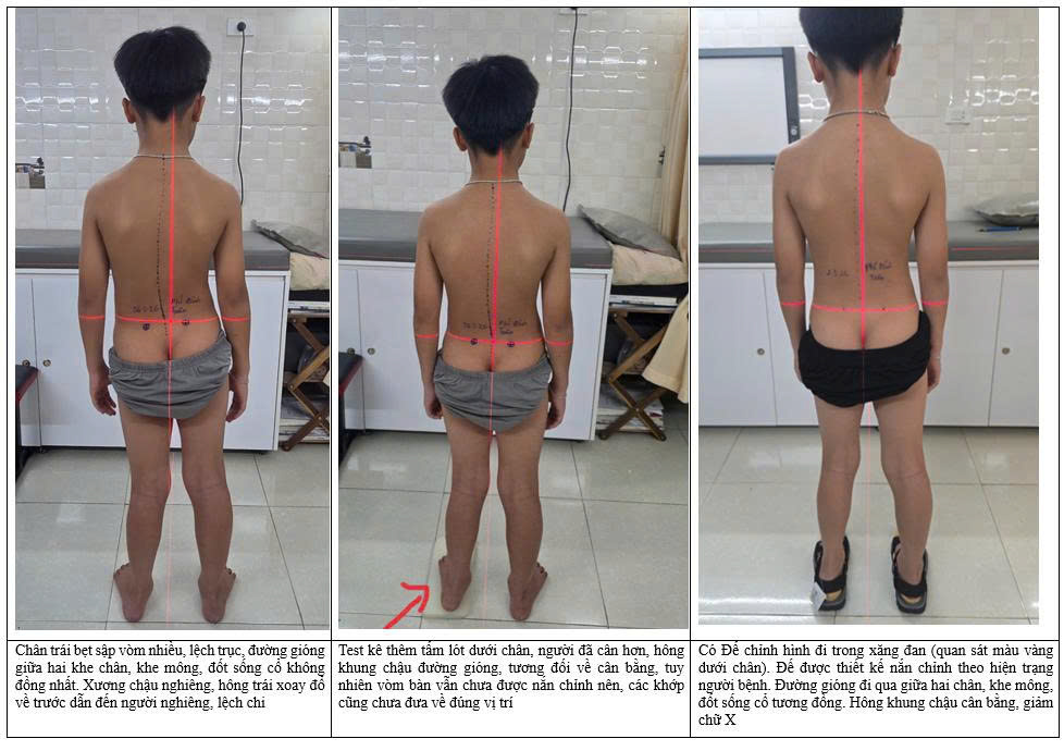 Quan sát đèn rọi lazer (phân tích dấu hiệu nhận biết Bệnh lý bàn chân bẹt) phổ biến ảnh 1 bên trái- và mức độ có đế ảnh 3 bên phải