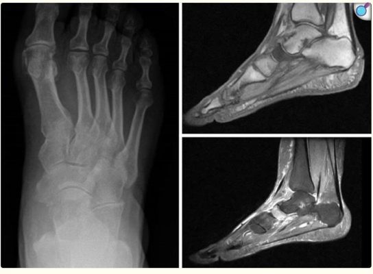 Dụng cụ chỉnh hình - Hội chứng Muller-Weiss (MWD)