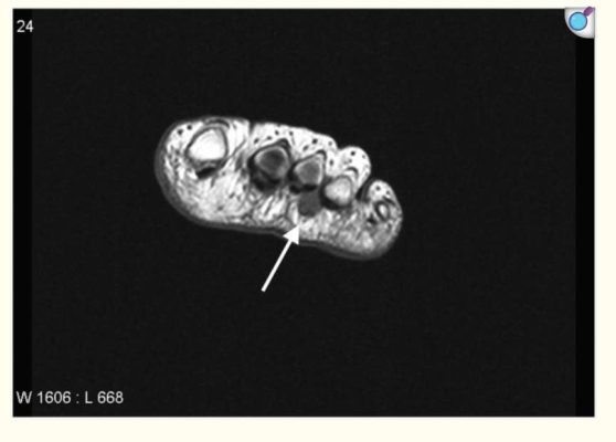 Dụng cụ chỉnh hình- Bệnh Morton