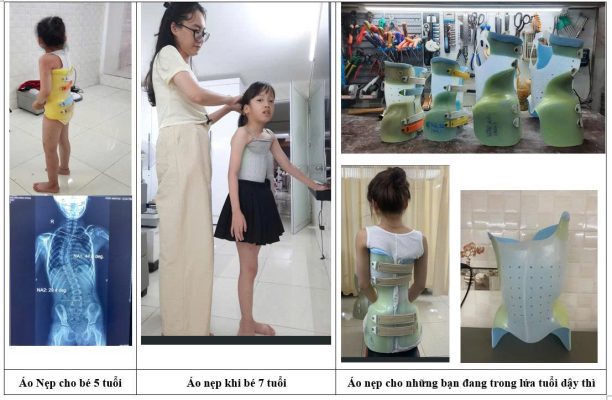 Cong vẹo cột sống điều trị với áo nẹp cho các con ở từng giai đoạn và độ tuổi khác nhau