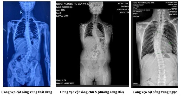 Các dạng cong vẹo cột sống