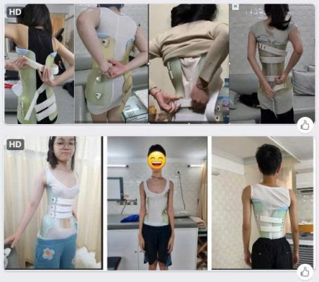 Phần lớn cong vẹo cột sống được phát hiện ở lứa tuổi dậy thìHình ảnh các bạn nhỏ (thanh thiếu niên) mặc áo nẹp điều trị cong vẹo cột sống