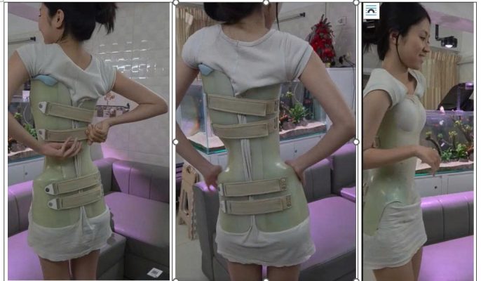 Áo nẹp cá nhân hóa- Cơ sở Chỉnh hình Lê Hoàn