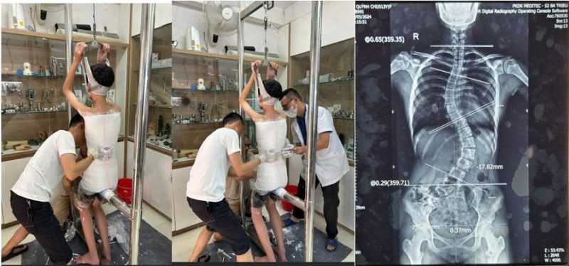 hình ảnh: vẹo cột sống, áo nẹp cá nhân hóa với quá trình bó bột lấy khuôn mẫu và nắn chỉnh trực tiếp ngay khi bó