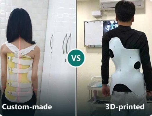 áo nẹp 3D và áo nẹp cá nhân hóa