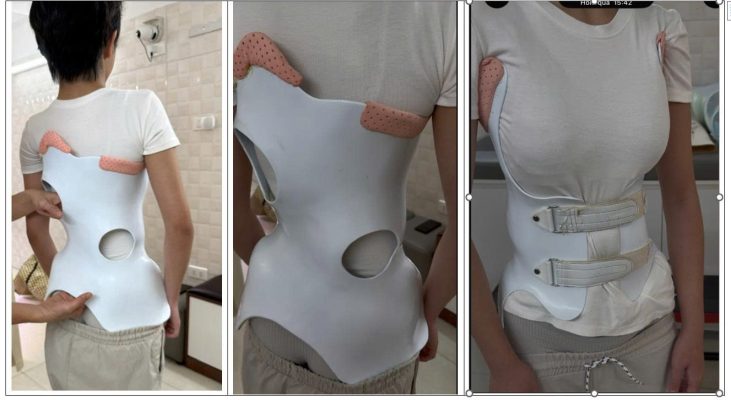 áo 3D của một cơ sở trung tâm chỉnh hình tại Hà Nội ( nguồn ảnh tham khảo lấy từ Bệnh nhân đang mặc)