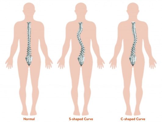 Hình ảnh minh họa: cột sống người bình thường và vẹo cột sống